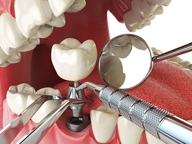 Best Emergency Wisdom Teeth Removal in Forrest, IL